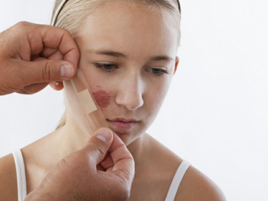 面部疤痕常见的三种修复术